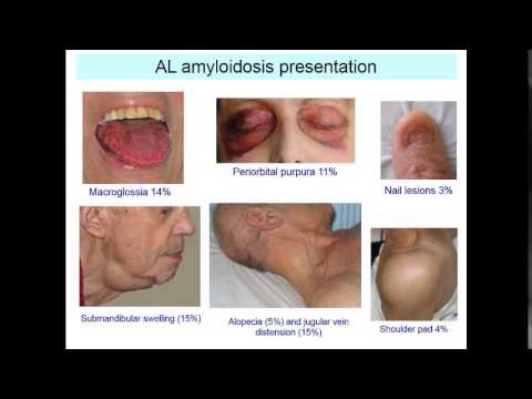 Vídeo: La Amiloidosis Por Gelsolina Finlandesa Causa Una Carga De Enfermedad Significativa Pero No Afecta La Supervivencia: Estudio De Fase II De FIN-GAR