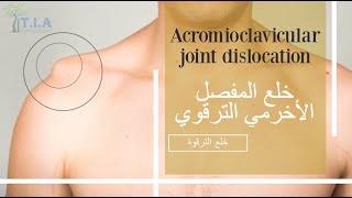 خلع الترقوة - خلع المفصل الأخرمي الترقوي    Acromioclavicular joint dislocation (subtitled)