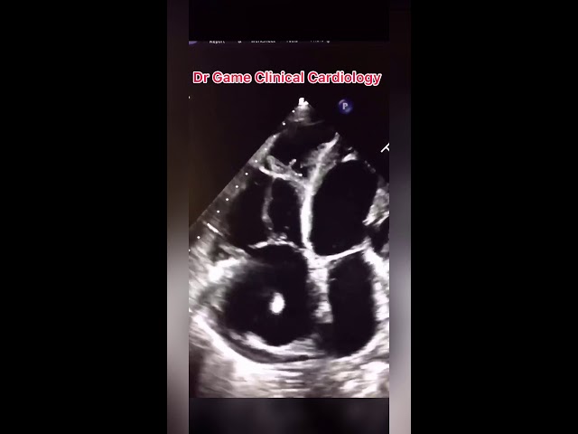 Right Heart Thrombus - Pulmonary Embolism - The Echo Channel