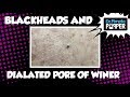 Blackheads and a Flippy Dilated Pore of Winer