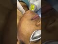 PrimeLase Laser Hair Removal | Laser Hair Removal at Mahendra Hair & Skin Clinic Zirakpur