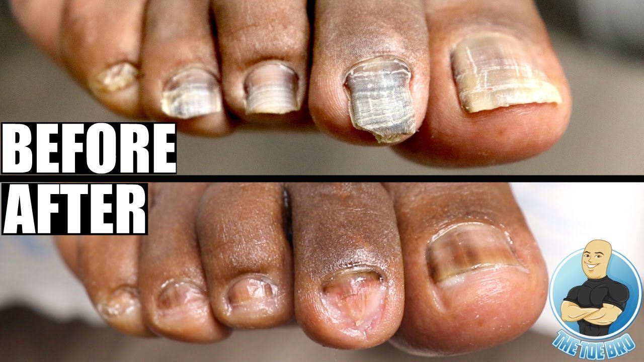 How to Stamp Out Toenail and Foot Fungus