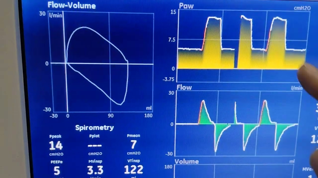Bedside MV cases | Episode 1 (GBS – Neuro lungs)