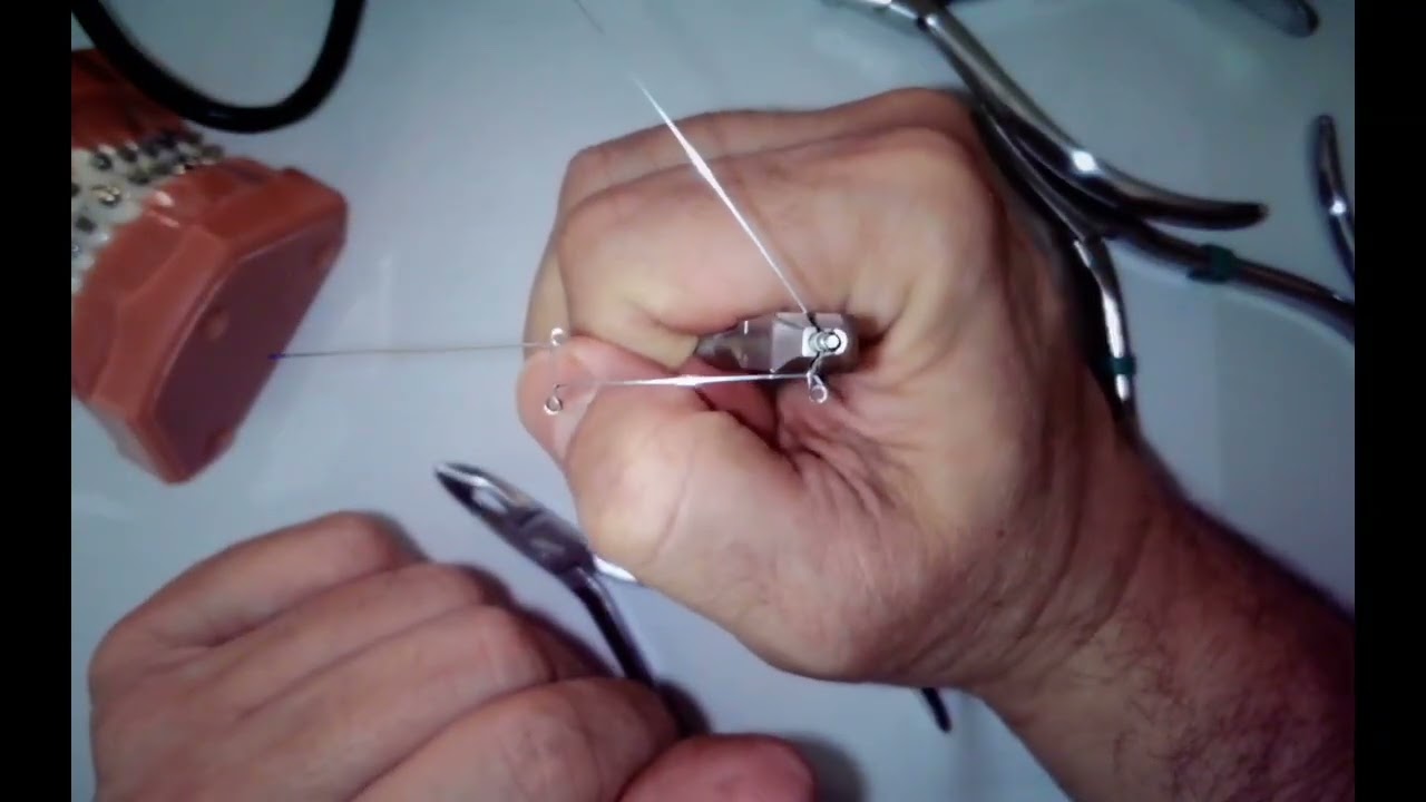 Upper Retraction Arch   Russian translation