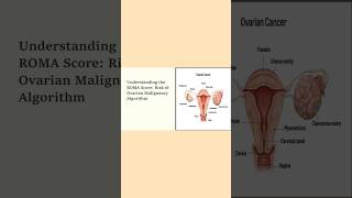 Understanding ROMA Score: Risk of Ovarian Malignancy algorithm #educational #medical #cancermarker