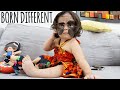 Luna: Our Baby With A Giant Birthmark | BORN DIFFERENT