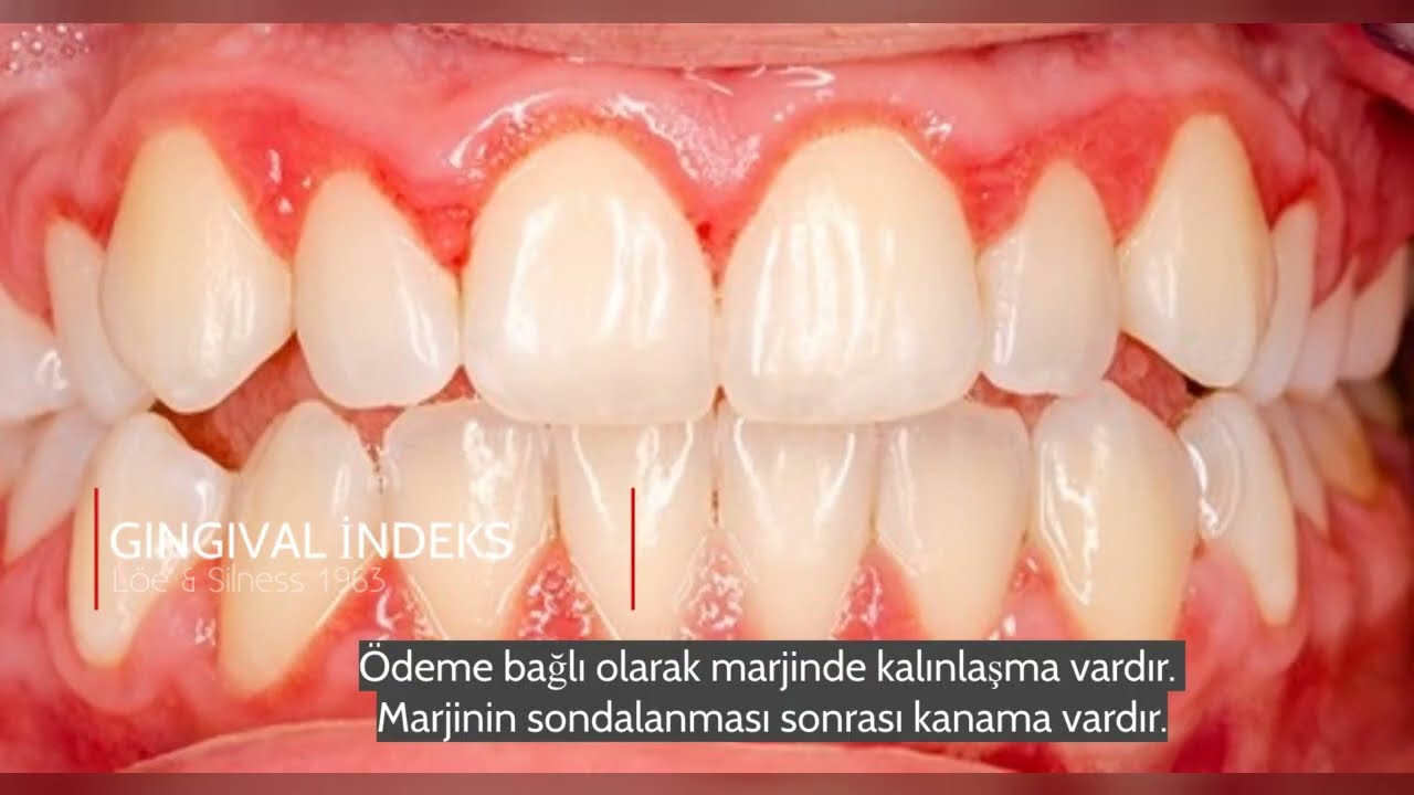 Periodontal Muayene Staj Bilgilendirme