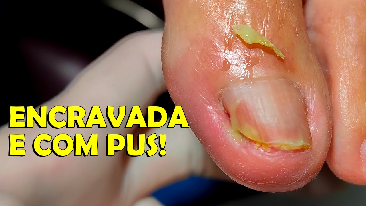 UNHA INFLAMADA E COM PUS - Vipé Podologia (Nails Lovers) - YouTube