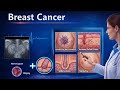 Carcinoma of Breast | Carcinoma In Situ, Clinical Features &amp; Management | Breast Surgery Lecture