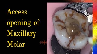 Access opening of Maxillary Molar