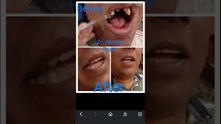 ‘Fixed bridge or prosthesis ‘ i.🥳🥰🥰Dr Moniya Gupta@smile designer🥰🥰😊