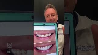 No Prep Porcelain Veneer Smile Makeover