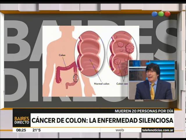 Entrevista Televisiva - Cáncer de Colon