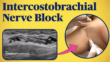 Ultrasound and Landmark-based Intercostobrachial Nerve Block