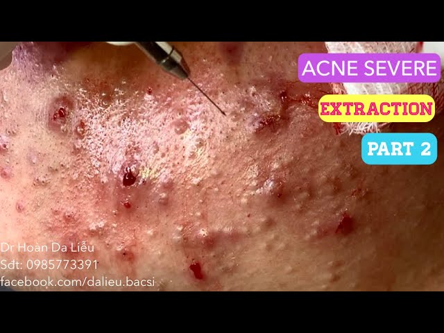 Mụn trứng cá mạch lươn cực nặng|Dermatologist, pimples blackhead, acne conglobata extraction part 2