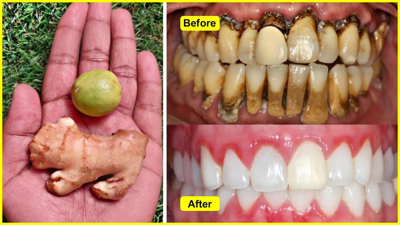 This recipe will brighten yellow dirty teeth like milk and pearl in 2