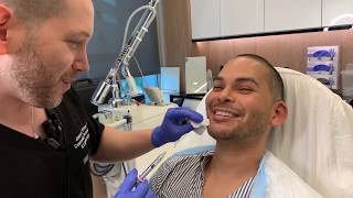 Male Facial Sculpting Chin and Lip Enhancement West Hollywood CA Dr Jason Emer