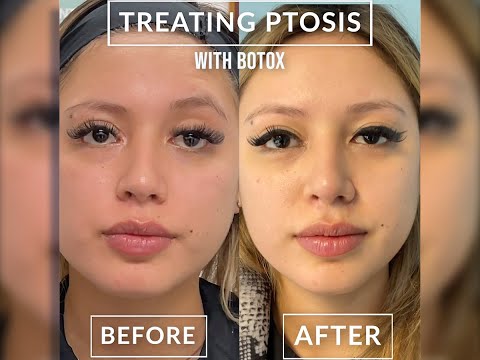 Video: Máte tip na botox?