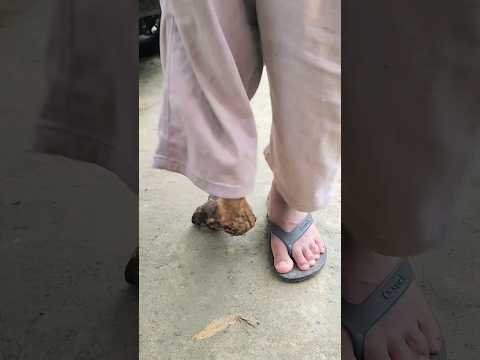 Video: Apa itu kaki terkutuk?