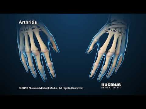 რევმატოიდული ართრიტი - საგიტარიუსი მეზღვაურთა სამედიცინო ცენტრი