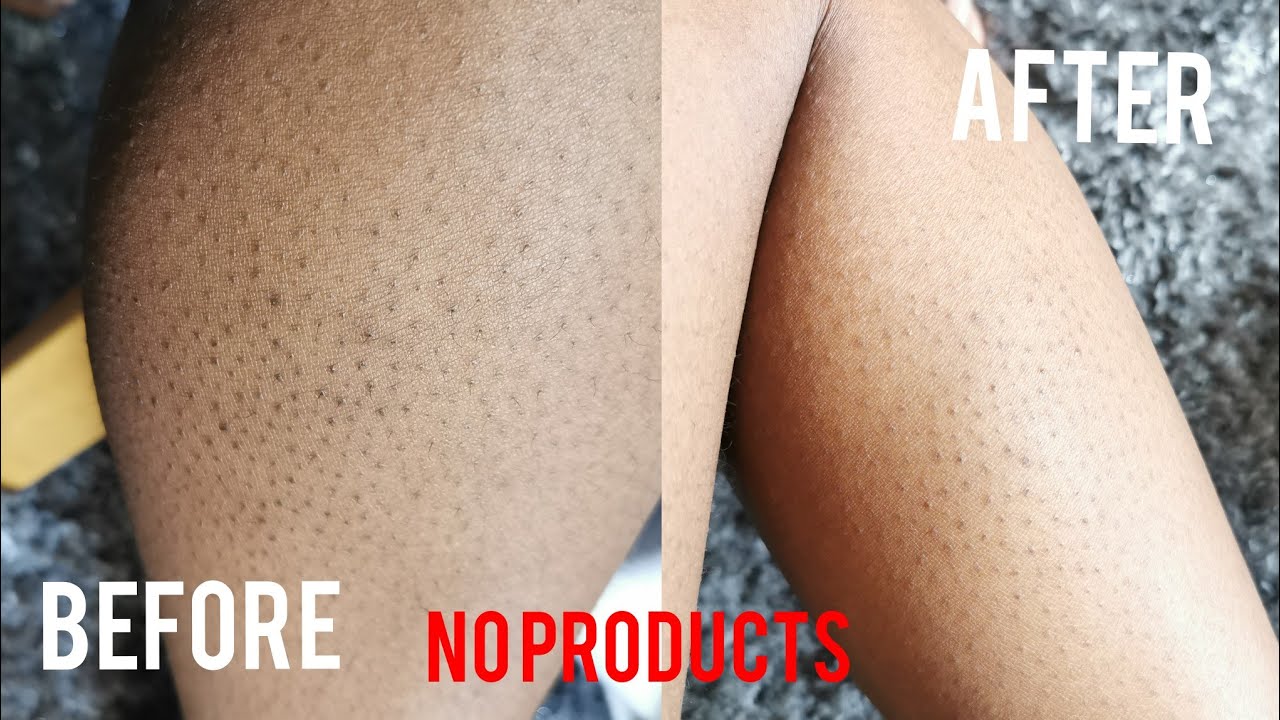 TREATING CHICKEN SKIN AND PIGMENTATION NATURALLY | NO PRODUCTS USED