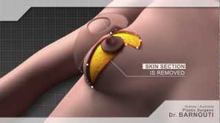 Cosmetic Surgery Animated Video | Breast Lift