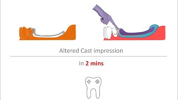 RPD Altered Cast Impression in 2 mins