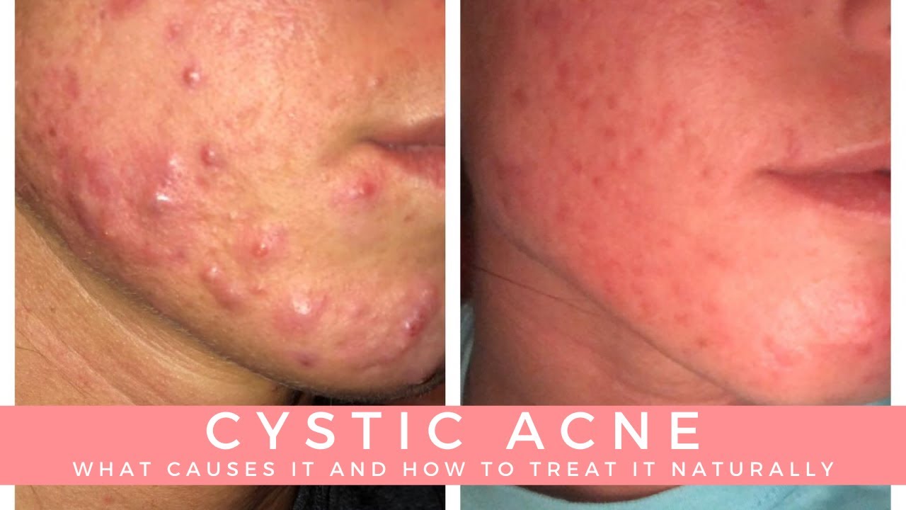 Cystic Acne How to Treat Sebaceous Pimples and Severe