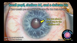 CataractCoach™ 2047: small pupil, shallow AC, and a delicate iris
