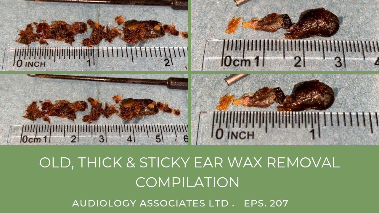 OLD, THICK & STICKY EAR WAX REMOVAL COMPILATION EP 207 YouTube