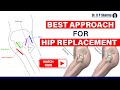 Know the best approach for hip replacement by 360degree hip surgeon in india  dr dp sharma