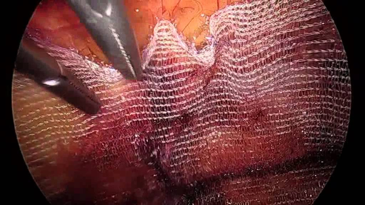 ProGrip : TEP mesh placement : laparoscopic inguinal hernia repair