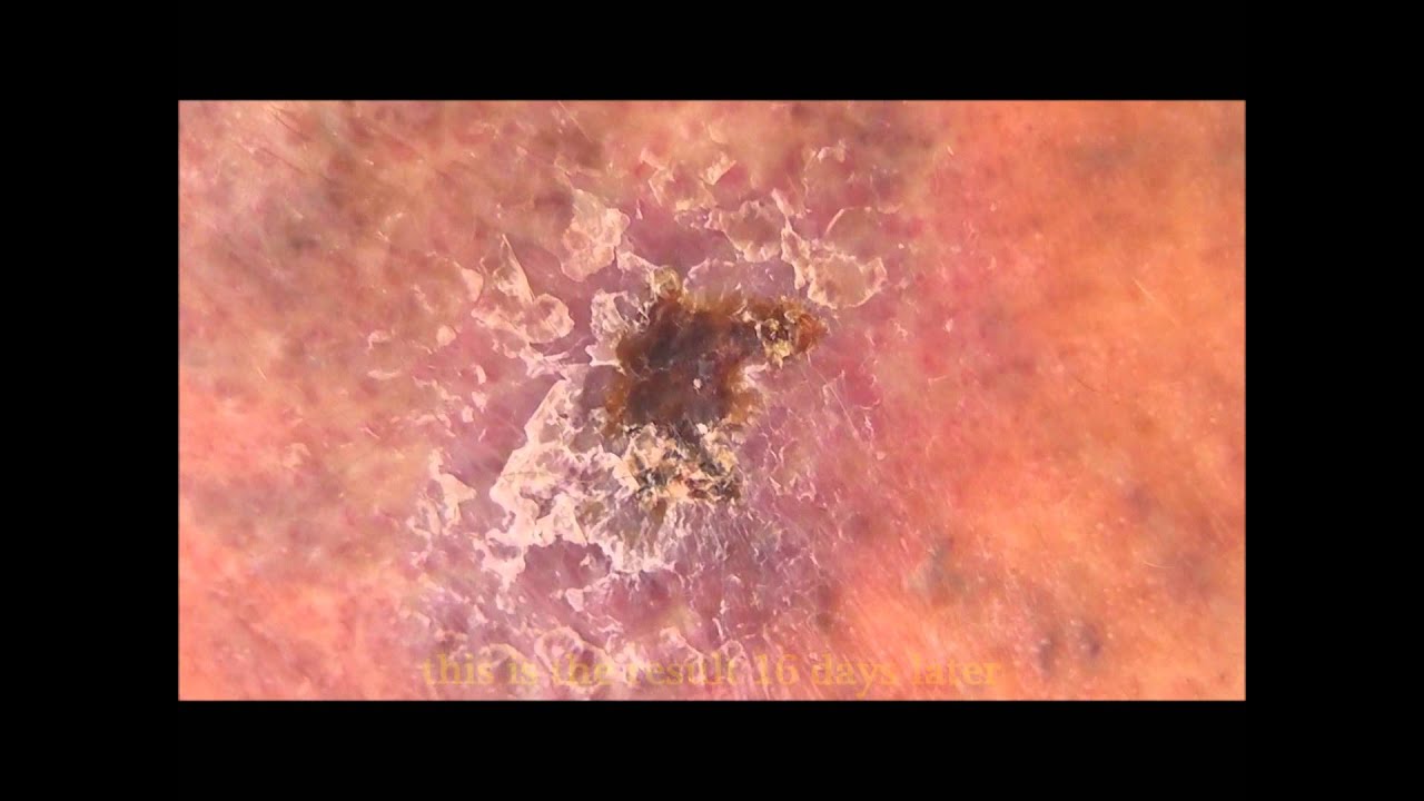 Management and healing of a venous ulcer above a patient's ... diagram of your leg 