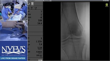 Live Case Presenation #8 Sessions in CLTI  Multi Tibal Artery Revascularization Fadi Saab Grand Rap