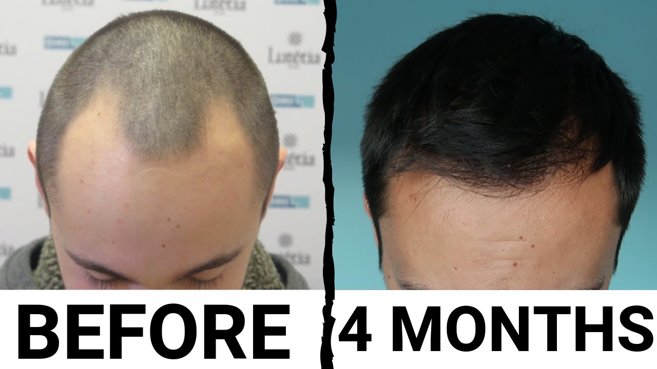 Hair Transplant After 4 Months What To Expect