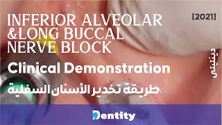 Inferior Alveolar Nerve Block & Long Buccal Technique | طريقة تخدير الأسنان السفلية screenshot 2