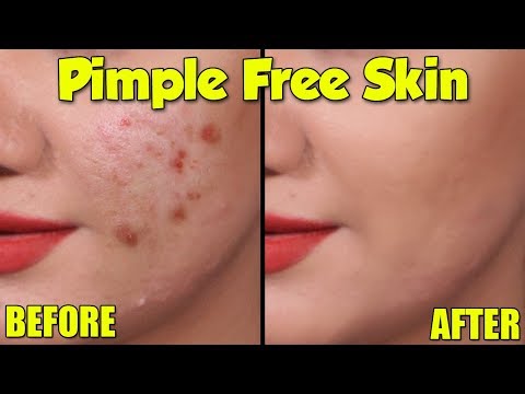 Hi guys, here are some easy tips which can help get rid of acne and clear, glowing & spotless skin. hope these were useful. business enquiries: styl...