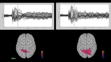 TMS EEG: Alzheimer’s Disease vs Healthy