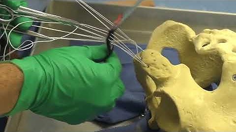 Reconstruction of Chronic Proximal Hamstring Tear: Description of a Surgical Technique