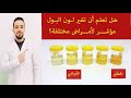 رغاوي البول وعلاقتها باعتلال الكلى السكري 