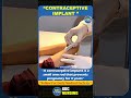 Contraceptive Implant Made Easy | OBG Nursing Shorts #norcet #nursingstudents