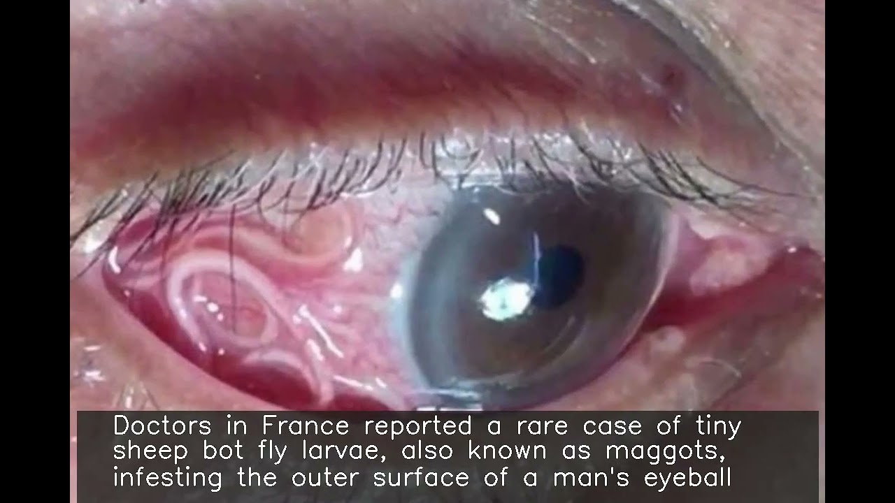 Over 12 maggots removed from man's eye in France; pic surfaces 