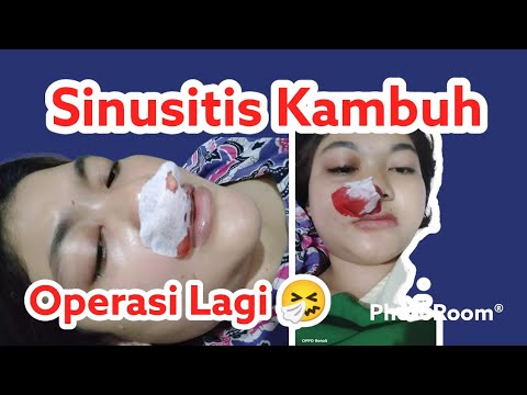 TERNYATA SINUSITIS SAYA KAMBUH // OPERASI SINUSITIS 