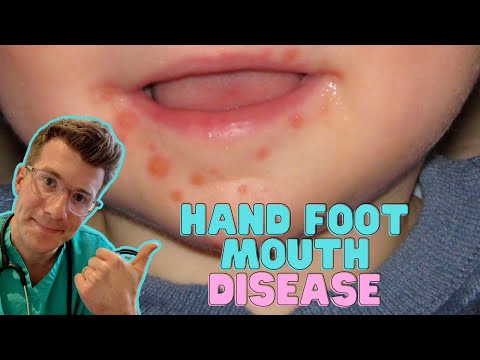 Videó: A kéz-, láb- és szájbetegség felismerése és kezelése: 10 lépés
