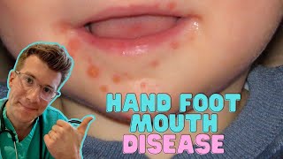 How to recognise & treat Hand Foot and Mouth Disease (Coxsackievirus) in kids | Doctor O'Donovan screenshot 3