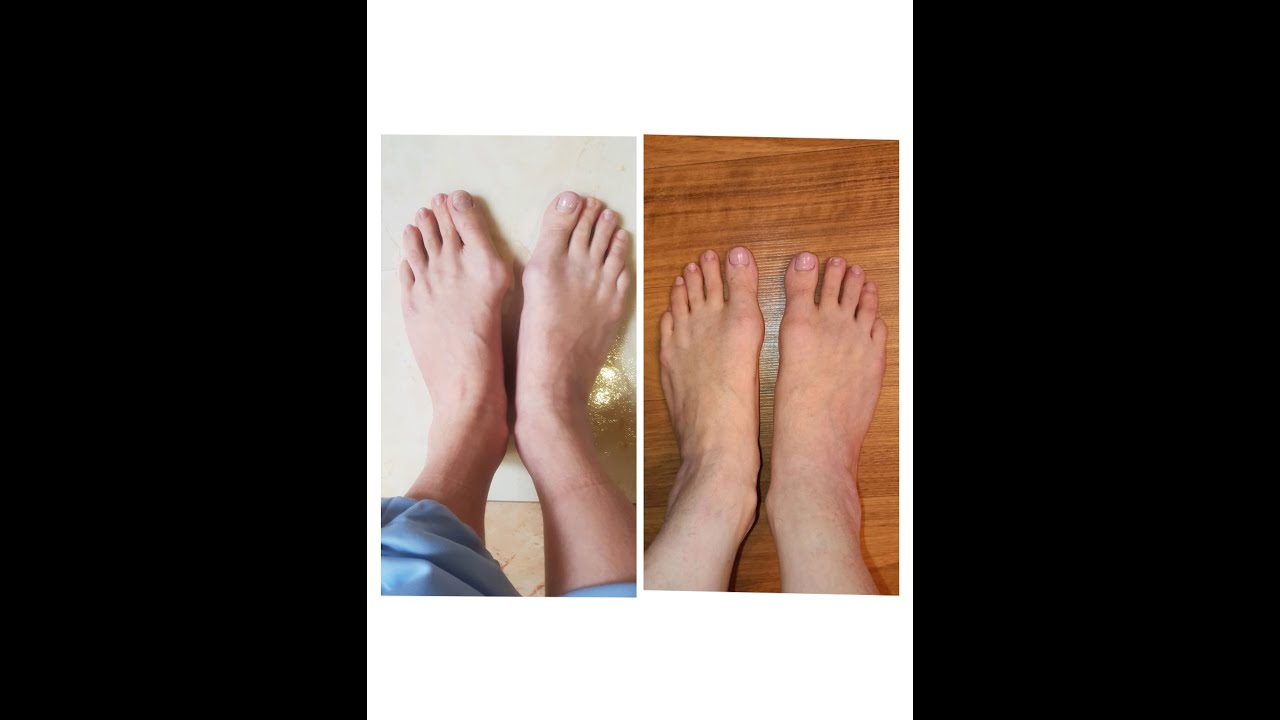 Халюс Вальгус. Hallux valgus «Шишка на большом пальце». - YouTube
