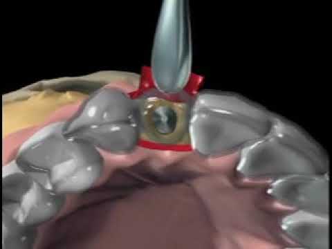 Video: Endosteal Implant: Typen En Procedures Van Tandheelkundige Implantaten