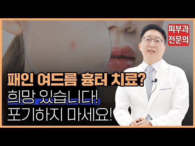 여드름 흉터 치료 '이렇게' 하시면 됩니다!ㅣ 피부과전문의