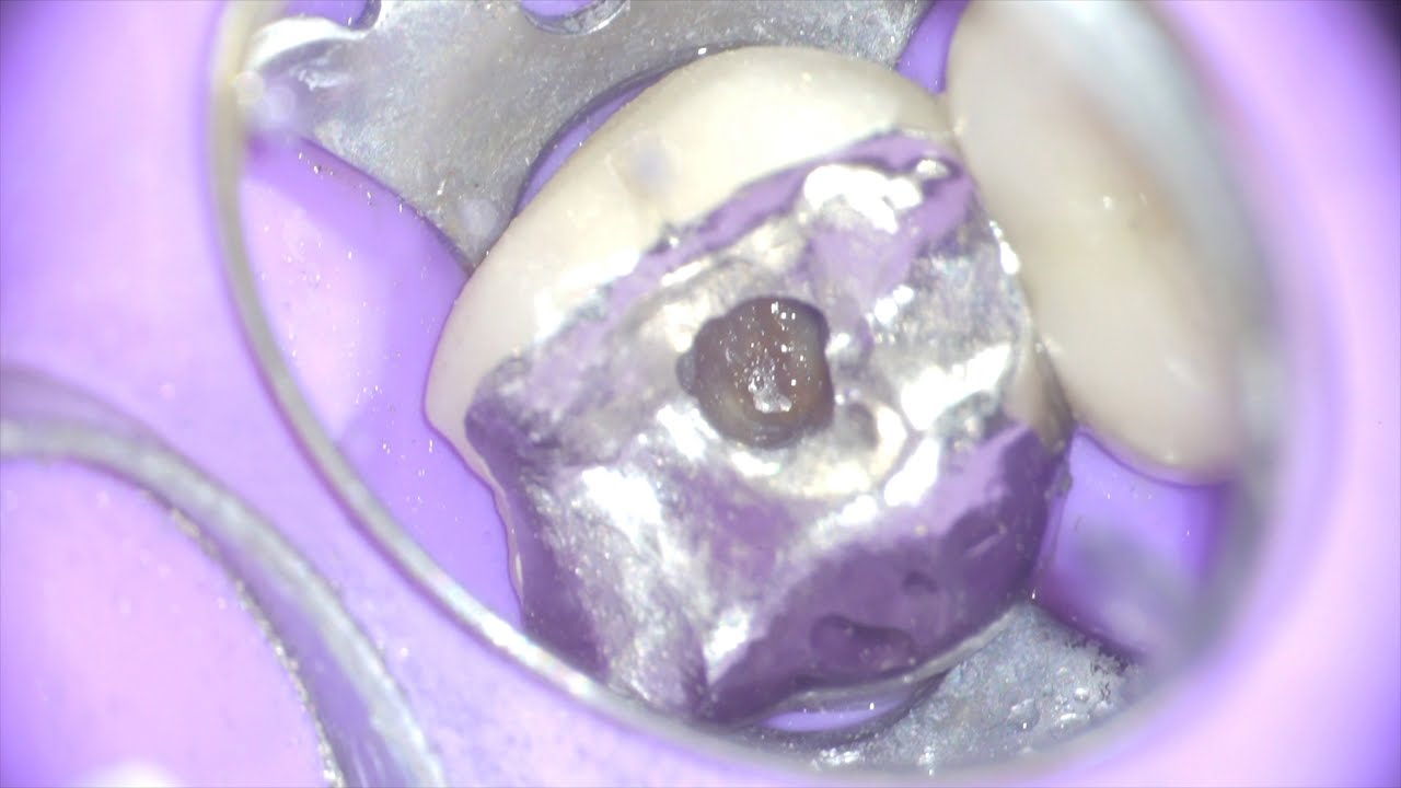 Root Canal Technique PART I (Molar Endodontics with Calcified Canals