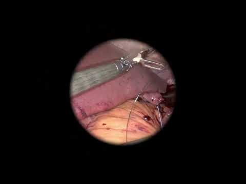 Robotic Total Gastrectomy with D2 lymphadenectomy.
